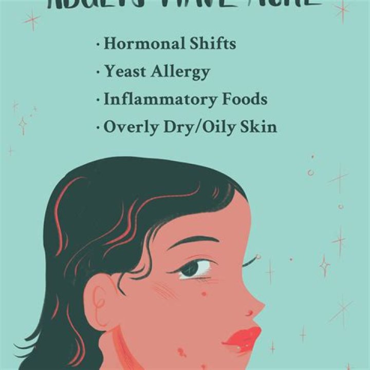 At what age does acne go away?