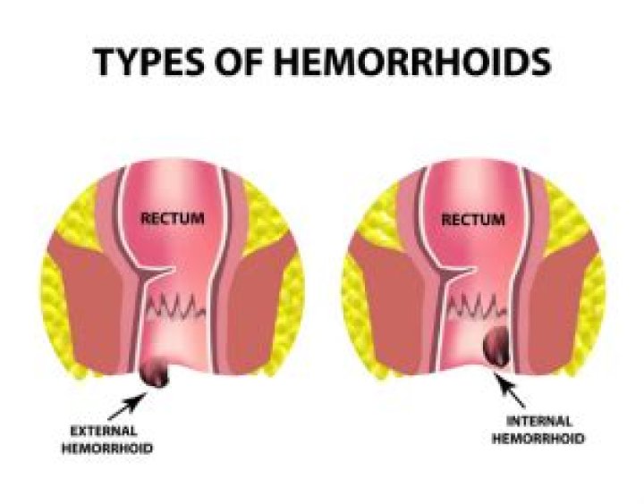 Can you push in an external hemorrhoid?