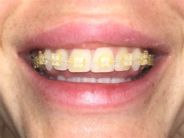 Do braces make your teeth yellow?