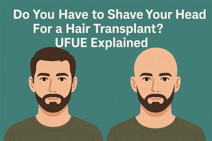 Do you have to shave your head for a hair transplant?