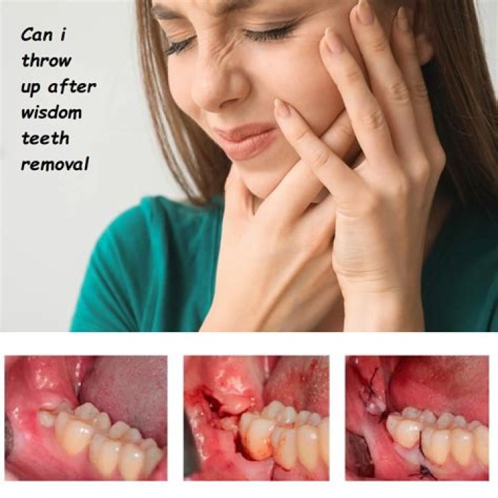 Do you say weird things after wisdom teeth removal?