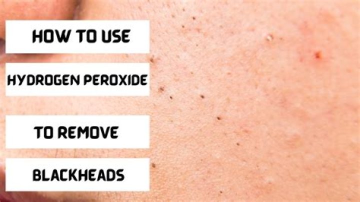 Does peroxide help blackheads?
