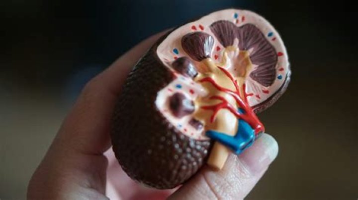 Does vitamin D cause kidney stones?