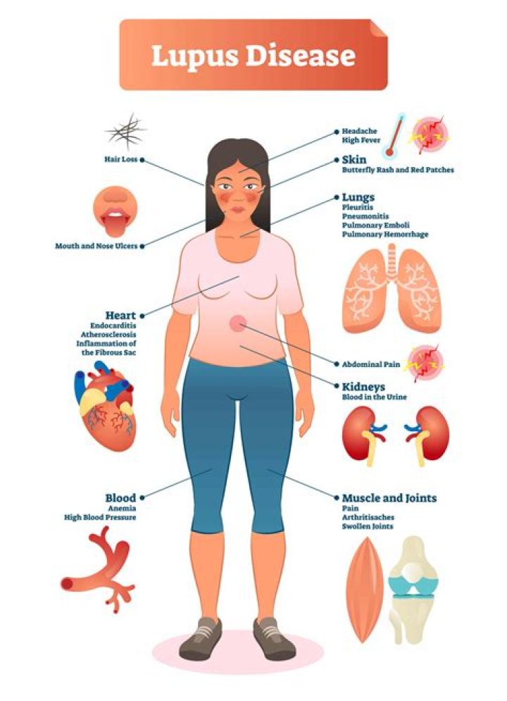 How do I explain lupus to my husband?