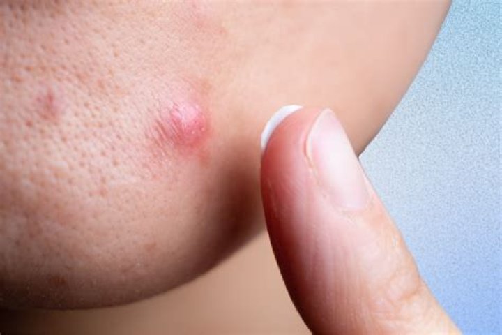How do you get rid of an underground pimple that won't go away?