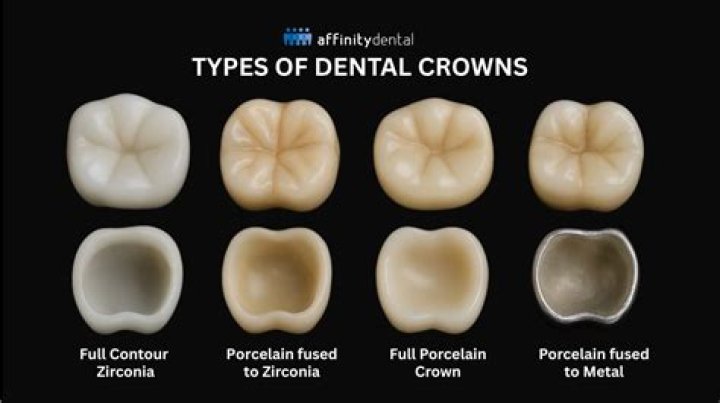 How many crowns do you need for side areas?