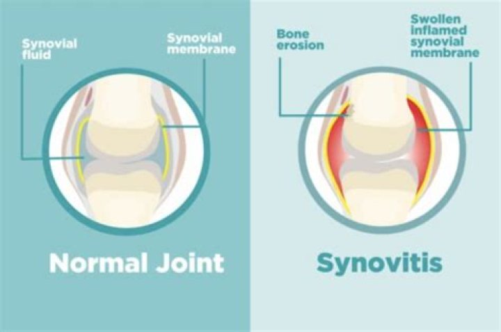 How painful is synovitis?