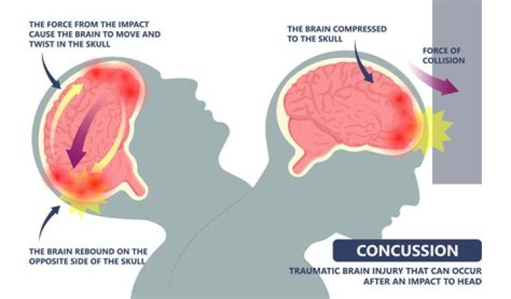 【How-to】How long after a concussion can you drink