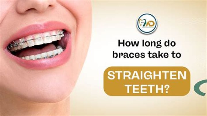 【How-to】How long does it take for braces to work