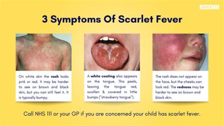 【How-to】How long does scarlet fever last