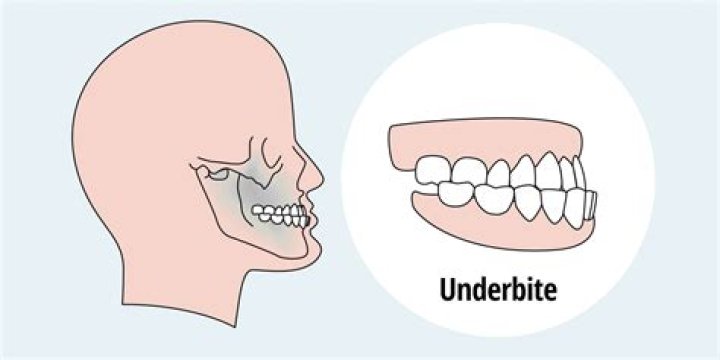【How-to】How to fix underbite naturally