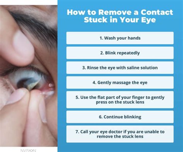 【How-to】How to get contact out of eyelid