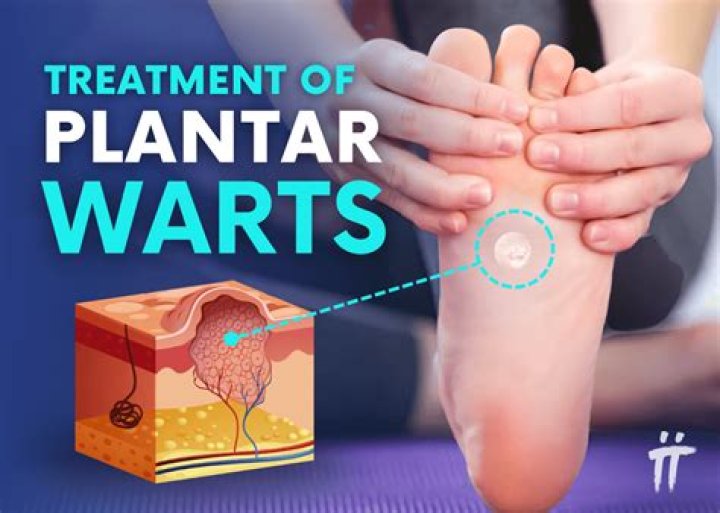 【How-to】How to get rid of plantar warts