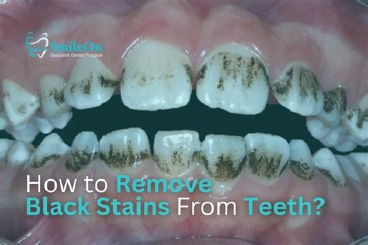 【How-to】How to remove brown stains from teeth