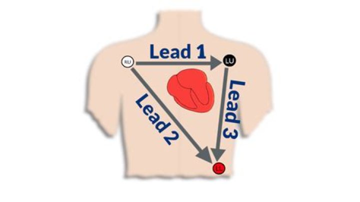 【How-to】What is a 3 lead ecg used for