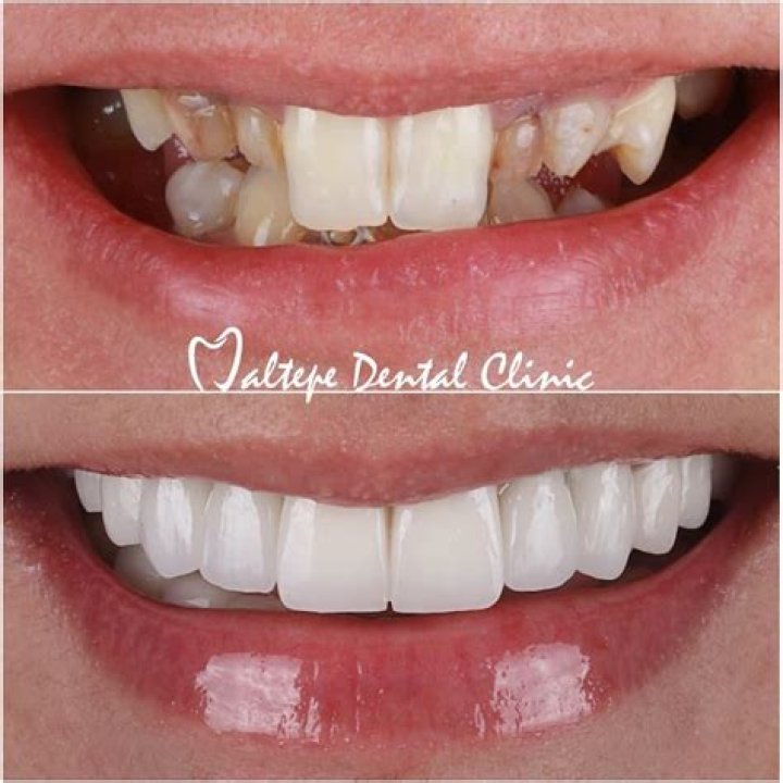 【How-to】What is bucktooth butternut - Howto.org