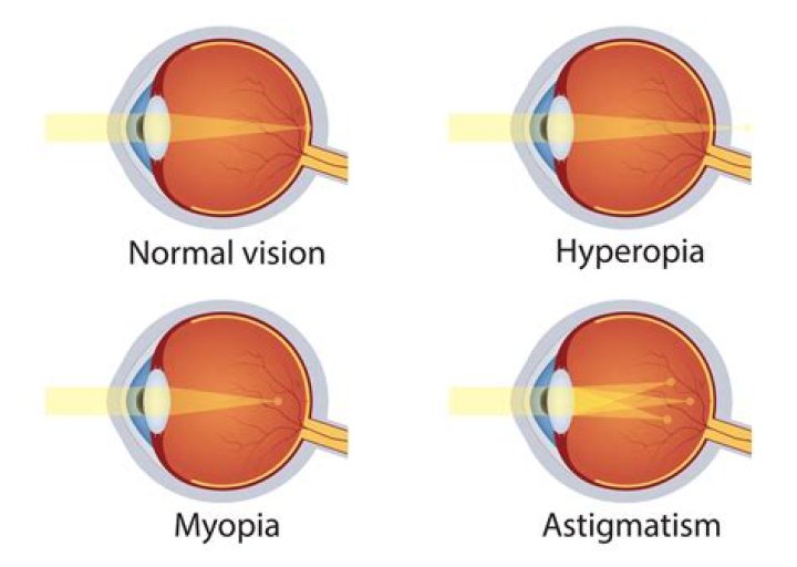 【How-to】What is the other name of presbyopia