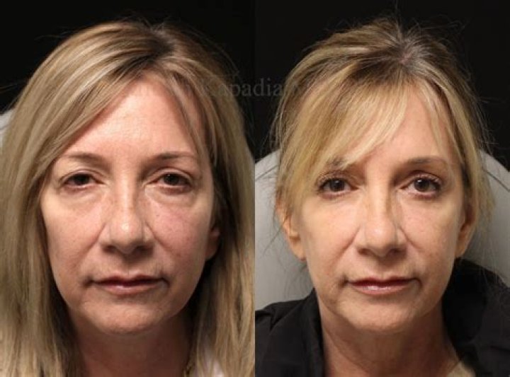Is crying before surgery normal?