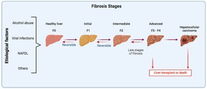 Is honey good for liver fibrosis?