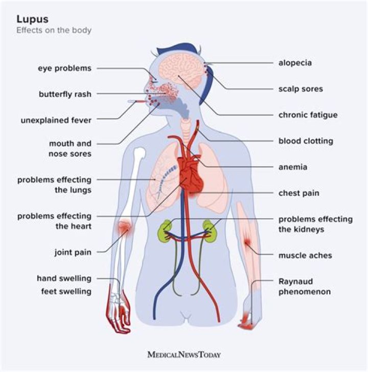 What are the 11 symptoms of lupus?