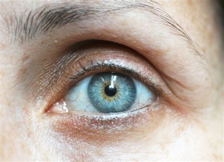 What do dementia eyes look like?