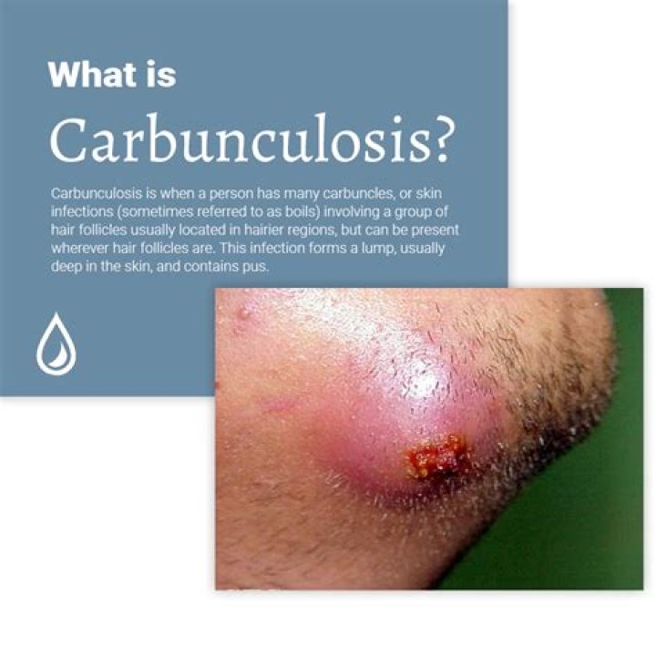 What does a carbuncle look like?