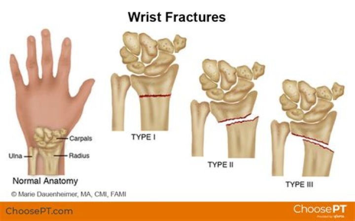 What does a hairline fracture in the wrist feel like?