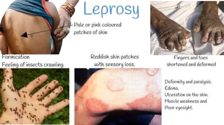 What is eye leprosy?