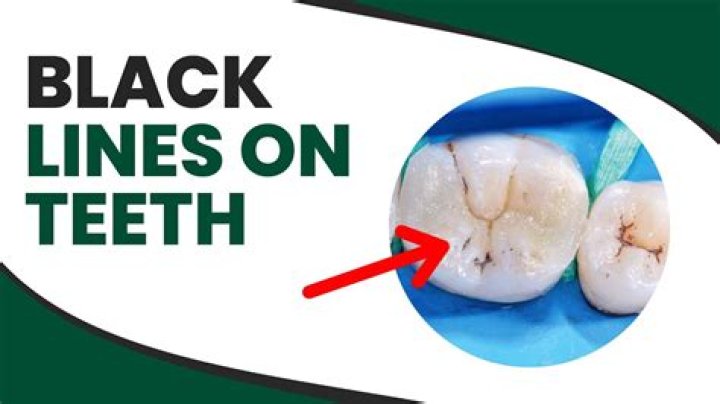 What is the black line around my tooth?