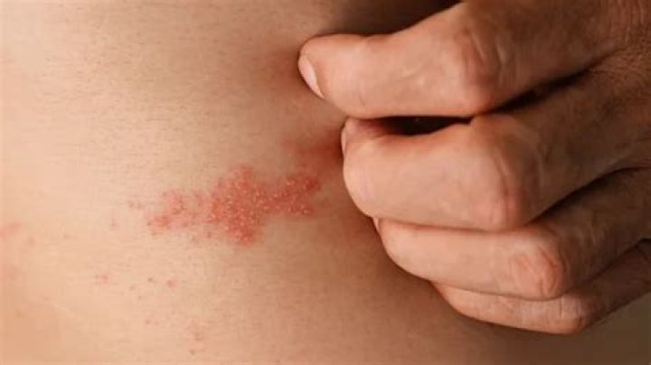 What other rashes look like shingles?