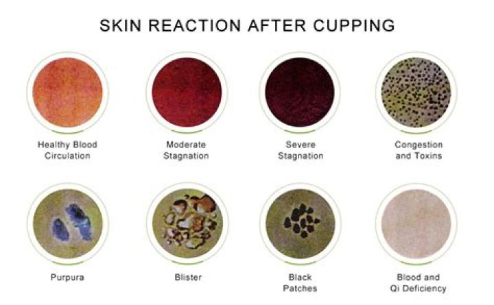 What toxins does cupping remove?