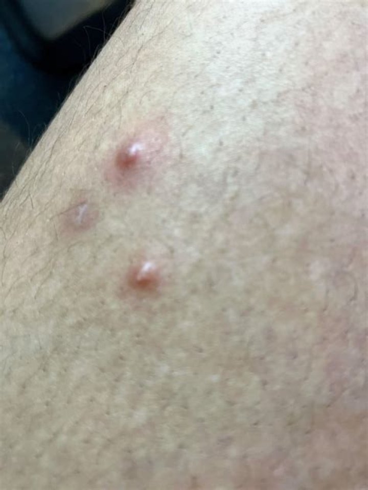 Why are there pimples in between my thighs?