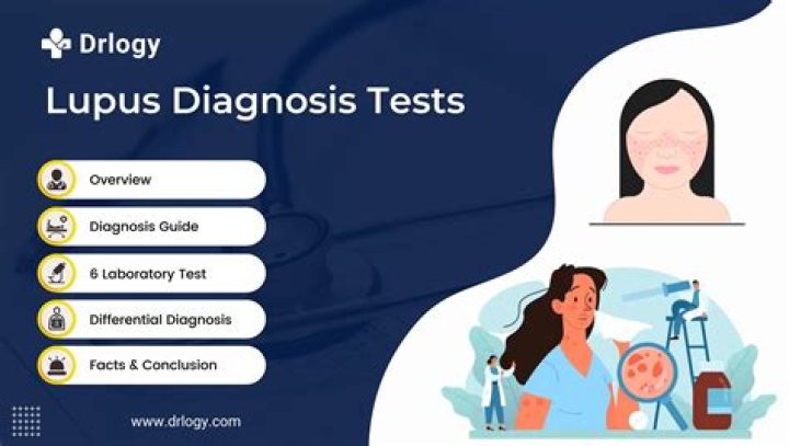 Why do doctors not diagnose lupus?