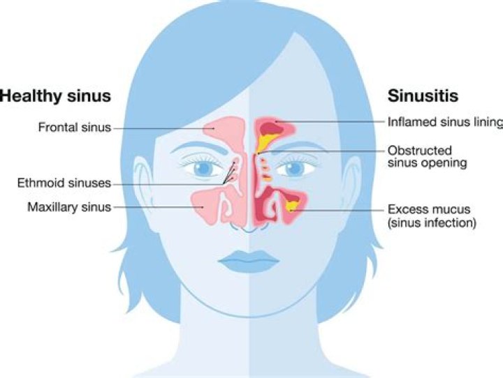 Why do I have so much sinus drainage?